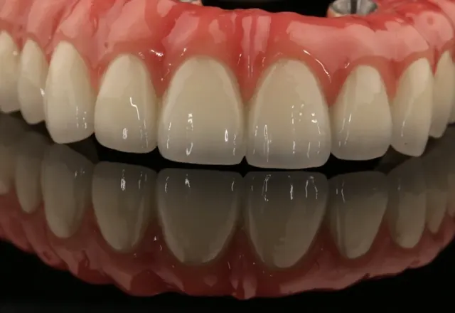 Bridge complet sur implants de type All-on-4